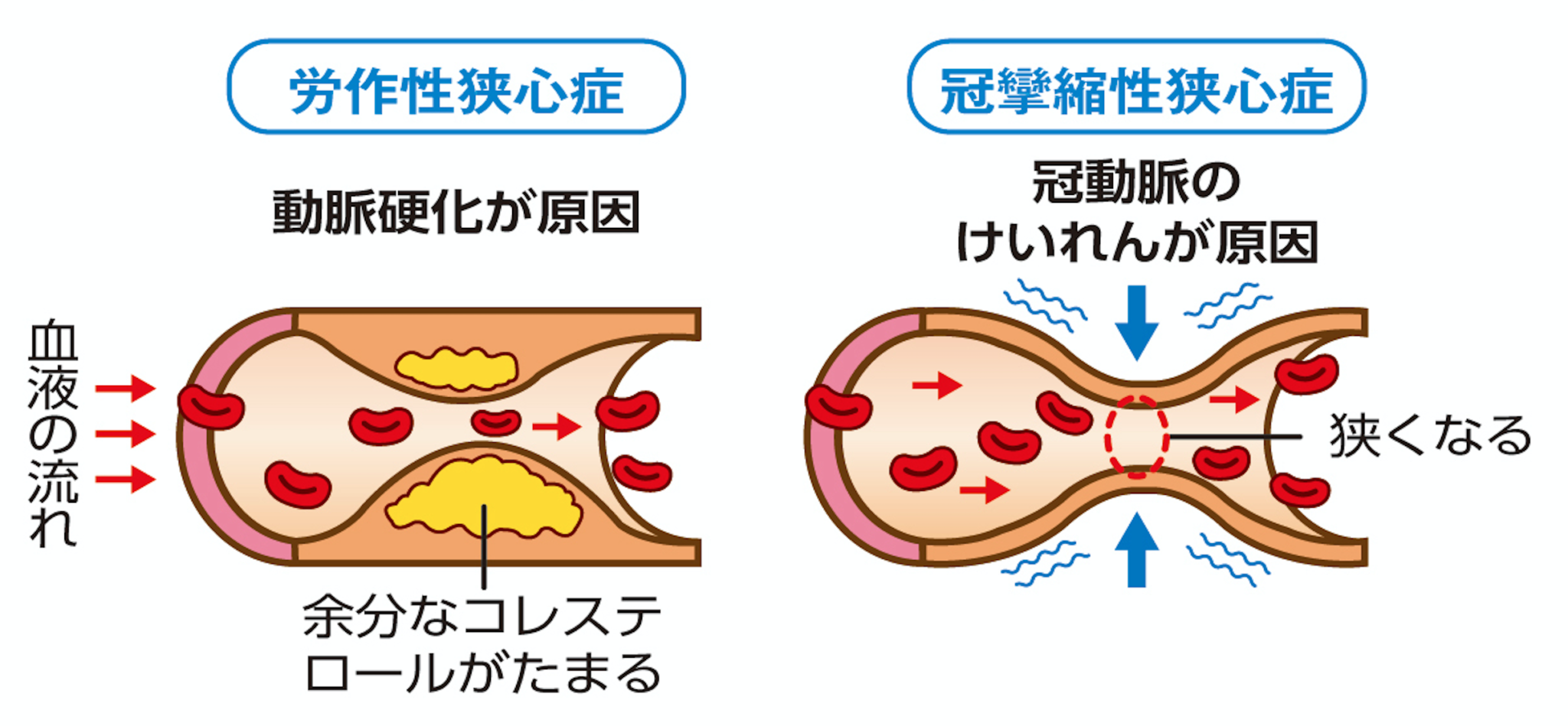 狭心症は安定性と不安定性の違いがありますか?